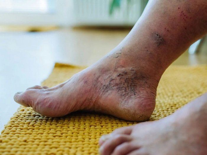 Diabetic Foot / சர்க்கரை பாதித்த கால் | AVS PLASTIC SURGERY & SKIN ...